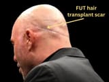 Joe-rogan-FUT-hair-transplant-scar