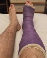 Purple_short_leg_cast