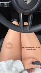 kiss shaped bruise