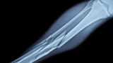 leg-break-mma-fighting-e1668192427161