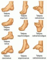 Congenital-Talipes-Equinovarus-Clubfoot-8