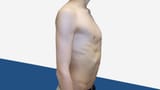 Pectus-Carinatum-pigeon-chest-1024x576