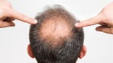 how-to-regrow-hair-on-bald-spot-fast