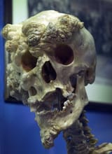 bone cancer