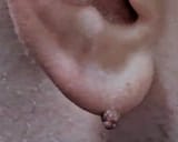 skin tag