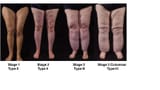 lipedema-stages-165700293