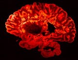 brain-mri-nih