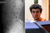mangione-spinal-surgery-gone-wrong