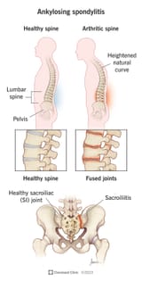 ankylosing-spondylitis