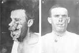 WWIItalianFacialReconstruction