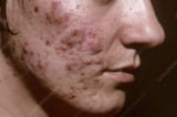 brutal acne scarring