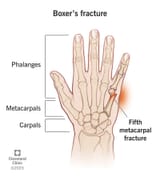 boxers-fracture