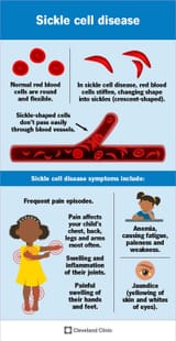 12100-sickle-cell-disease