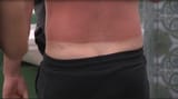 sunburn