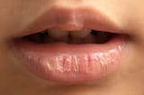 Chapped_Lips