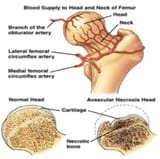 Avascular-necrosis-osteonecrosis-of-bone-Avascular-necrosis-of-the-hip-occurs-when