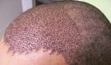 HAIR-TRANSPLANT-IN-TURKEY-1[1]