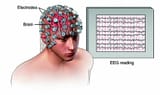 Electroencephalography-21-The-monitor-shows-the-Encephalogram-EEG-which-shows-the