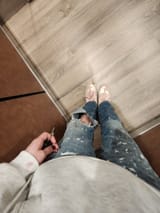 bruises