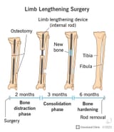 24316-limb-lengthening-surgery