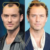Jude-Law-Hair-Transplant1