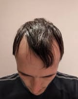 BALDY