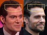 henry-cavill-hair-transplant-before-and-after