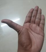 thumb bent