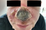 mpox