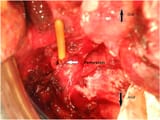 Exploratory-laparotomy-Perforation-of-the-neovagina-was-confirmed-and-primary-closure