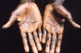 Monkeypox+on+hands_ae2c615c-d286-4e6d-8fff-cc8062d0bef4-prv[1]