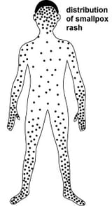 smallpox