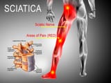 sciatic-pain-orange-county