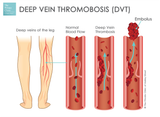 deep-vein-thromobosis-dvt-diagram