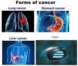 foehn cancer