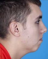 Barrera-Chin-Augmentation-Modern-Male-San-Antonio