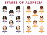 Stages-of-Alopecia