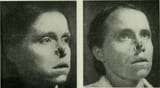 Radium Girls