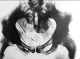 albert fish x ray