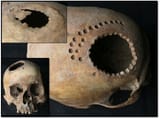 Trepanned-skull-practice