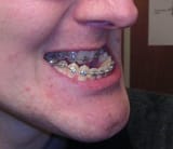 Mandibular_prognathism_pre-surgery