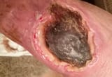 Spider-bite-hole-leg-739187
