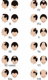 Clinical-classification-of-MPHL-according-to-the-Hamilton-Norwood-scale-MPHL-is