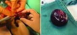 A-A-necrotic-cystic-tumor-was-found-by-an-upper-abdominal-horizontal-incision-B