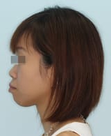 Affordable-Braces-Singapore-Before-Bimaxillary-Proclination
