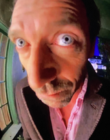 tfw sarcoidosis