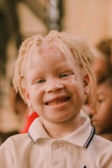 petit garçon africain albinos