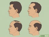 v4-460px-Tell-if-Your-Hairline-Is-Receding-Step-6