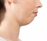 dysgenic femcel