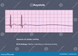 ecg critical failure